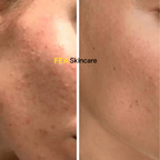 Acne Care Serum
