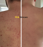 Acne Face & Body Scrub