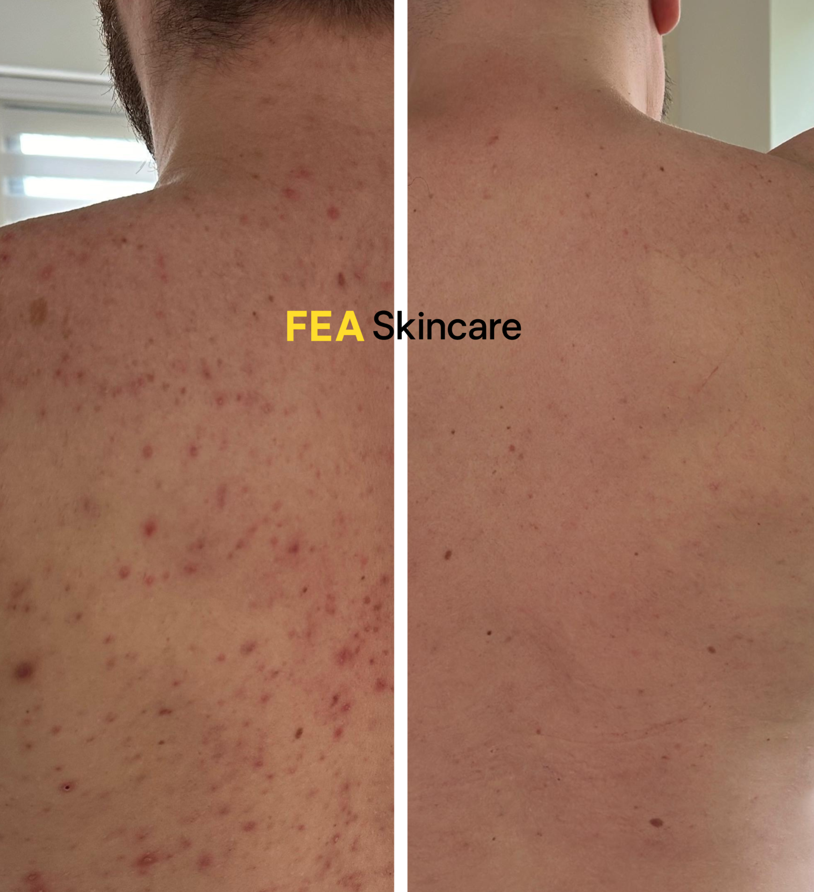 Acne Face and Body Scrub